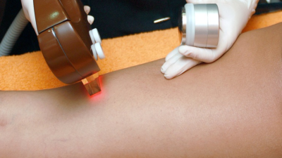 epilation